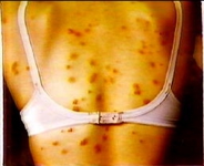 ダニ刺され痕（背中）